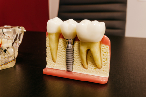 Best Dental Implant Brands in The World