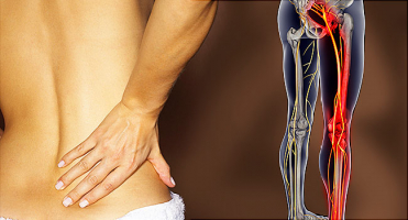 Best Effective Solutions for Sciatica Pain