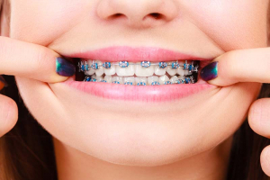 Best Places for Braces in Wisconsin