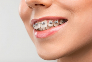 Best Places to Get Braces in New Mexico