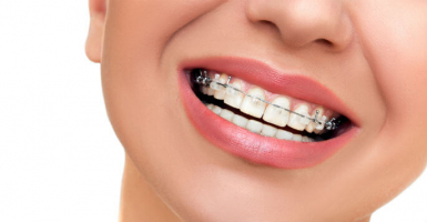 Best Places to Get Braces in Texas
