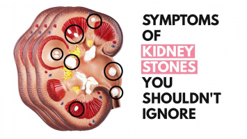Signs and Symptoms of Kidney Stones