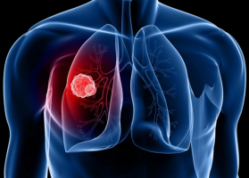 Signs and Symptoms of Lung Cancer