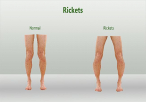 Signs and Symptoms of Rickets