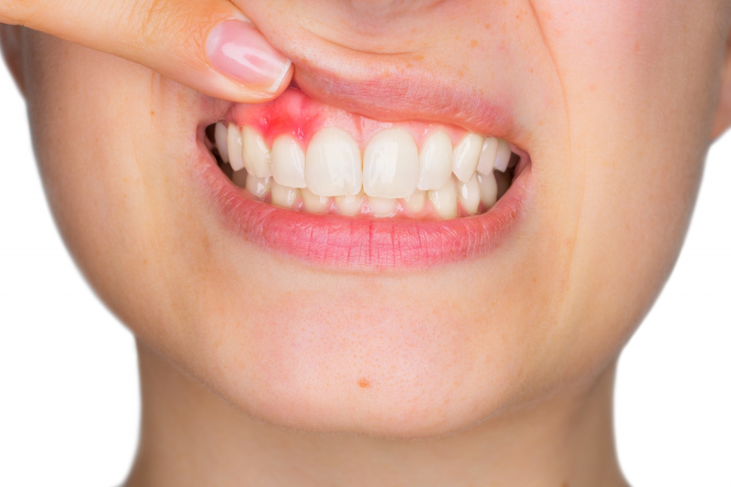 Bleeding Gums and Tooth Loss