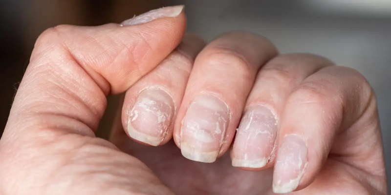 Brittle or spoon-shaped fingernails
