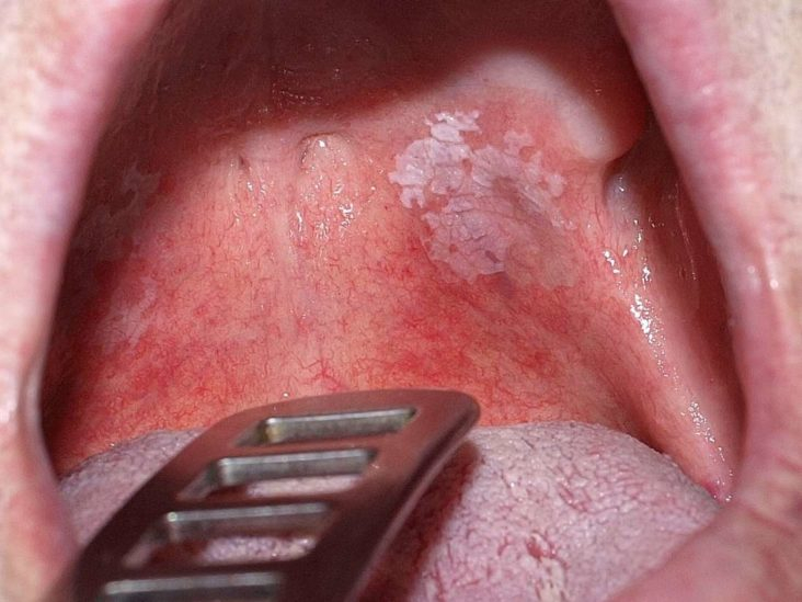 Creamy white lesions on your tongue, inner cheeks, and sometimes on the roof of your mouth, gums and tonsils