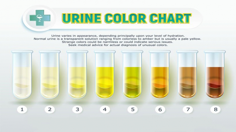 Dark urine