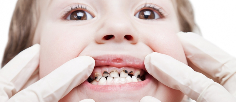 Erodes tooth enamel