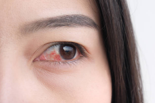 Eye inflammation