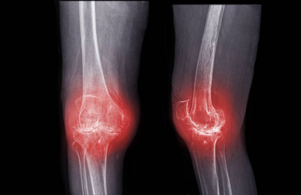 Greater Risk of Bone Fractures