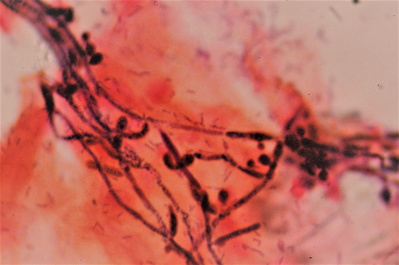 Photo on Wikimedia Commons (https://upload.wikimedia.org/wikipedia/commons/a/a7/Vaginal_candidiasis%2C_Gram_stain.jpg)