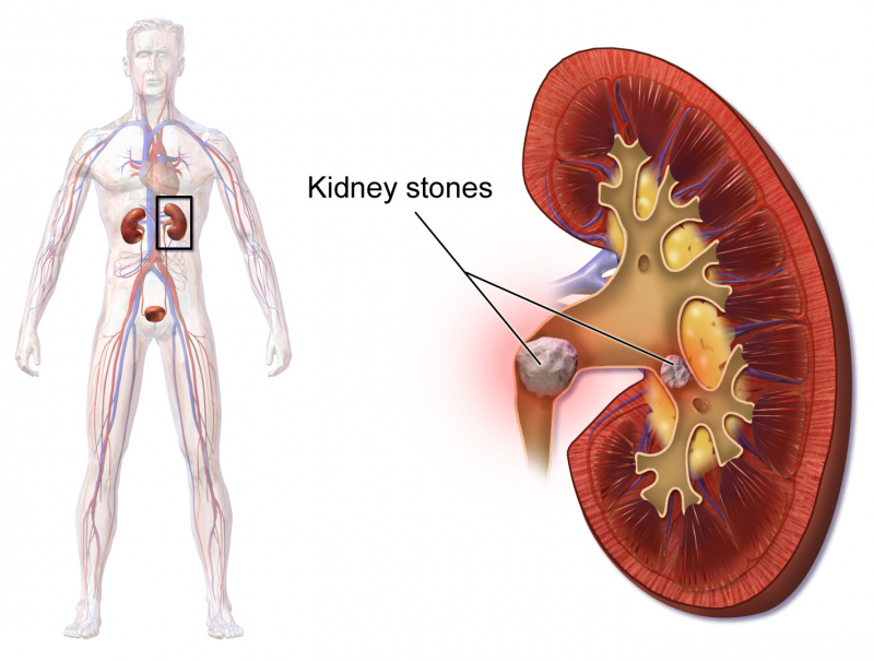 Photo on  Wikimedia Commons (https://commons.wikimedia.org/wiki/File:Blausen_0595_KidneyStones.png)