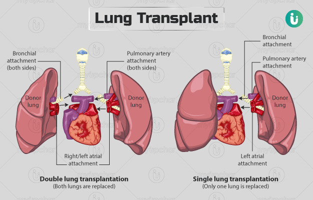 The differences between double and single lung transplant (myupchar.com)