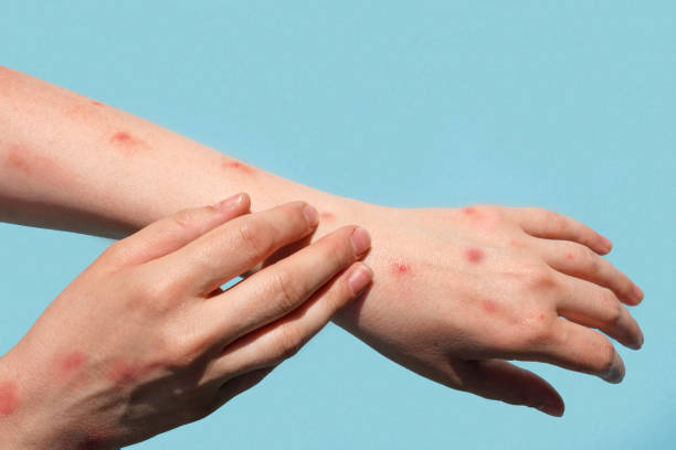 Skin outbreaks