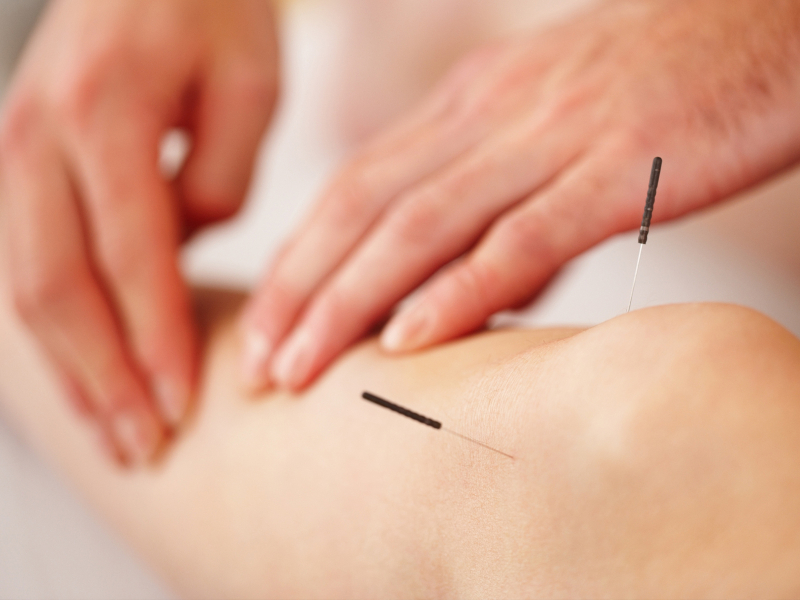 Try Acupuncture or Acupressure