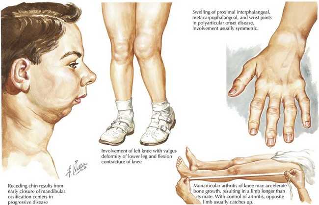 Arthritis Rheumatism